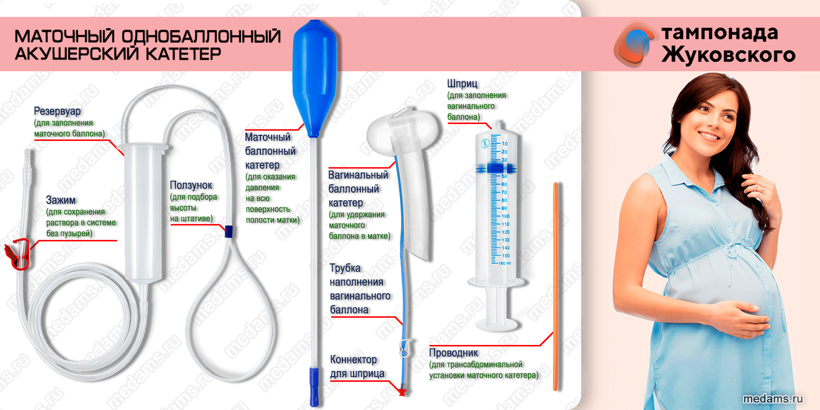 Маточная тампонада | однобаллонный акушерский катетер Жуковского