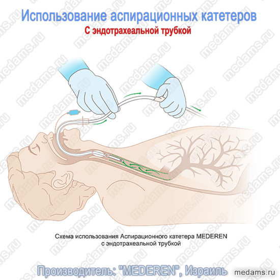 ispolzovanie_aspiracionnyh_kateterov_s_endotrahealnoj_trubkoj.jpg